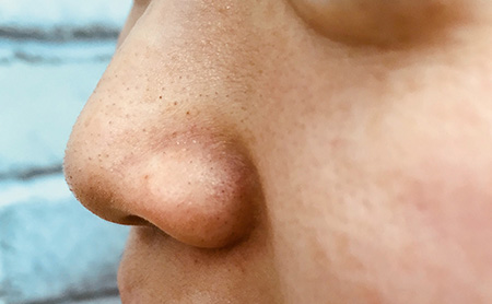 ハイドラフェイシャル症例：鼻施術前