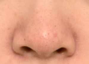 ハイドラフェイシャル症例：鼻の施術後