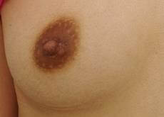 胸の整形の症例写真（術後）
