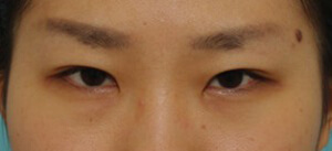 二重整形・目元整形の症例写真(術後)