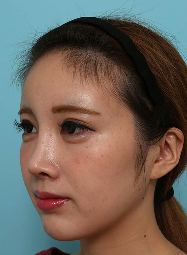 額と鼻の整形の症例写真（術後）