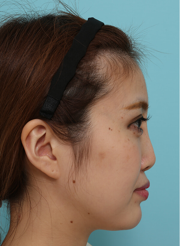 額と鼻の整形の症例写真（術前）