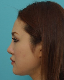 鼻の整形の症例写真（術前）
