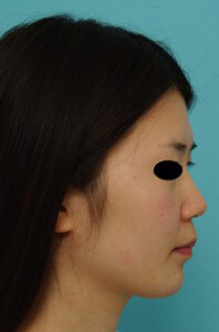鼻の整形の症例写真（術前）