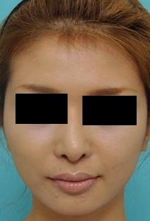 鼻の整形の症例写真(術後6カ月)