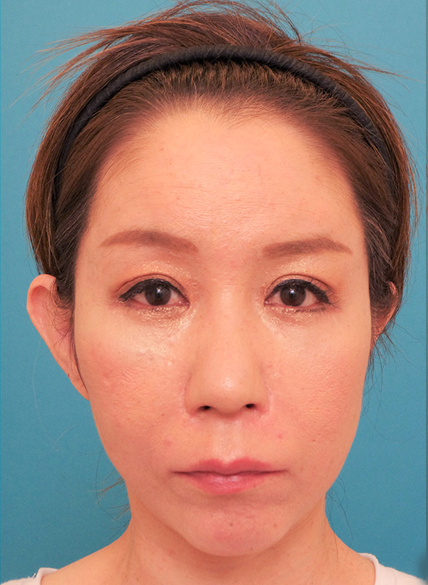 額と頬、目元と鼻の整形の症例写真（術後）