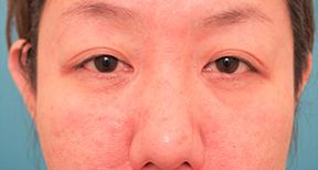 額と頬、目元と鼻の整形の症例写真（術前）