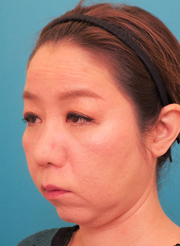 額と頬、目元と鼻の整形の症例写真（術前）