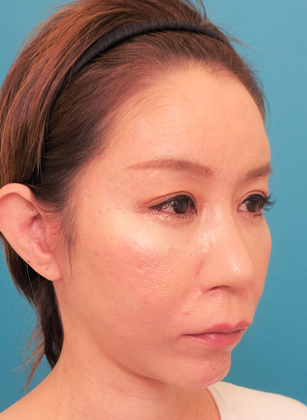 額と頬、目元と鼻の整形の症例写真（術後）