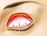 眼瞼下垂術（挙筋前転固定術）の術式 2