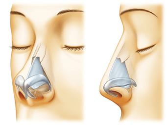 一般的な鼻中隔延長術の術前