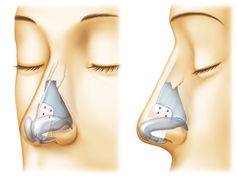 一般的な鼻中隔延長術の術後