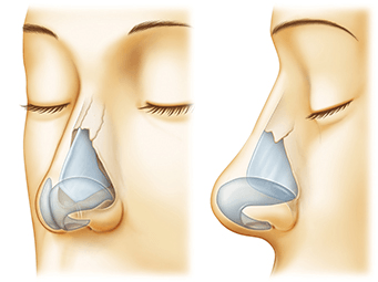 だんご鼻の鼻中隔延長術の術前