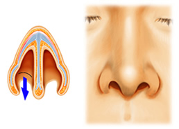 鼻孔縁形成術 術式 1