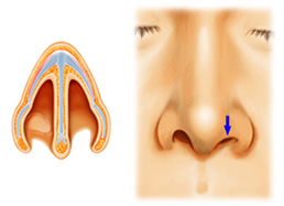 鼻孔縁形成術 術式 3