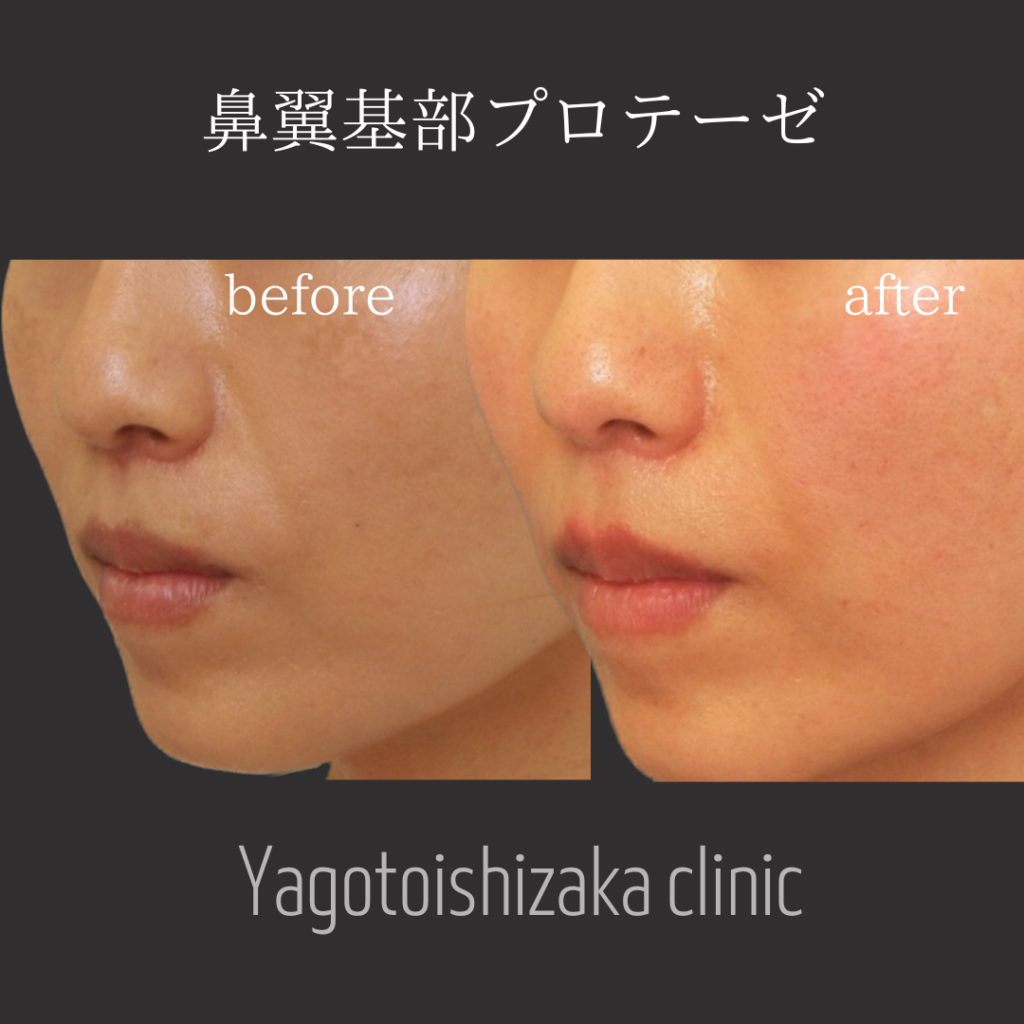 鼻翼 鼻翼基部プロテーゼとはなんぞや🧸？ | スタッフブログ